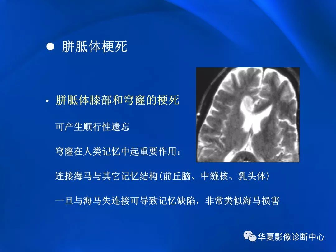 胼胝体病变影像学表现二