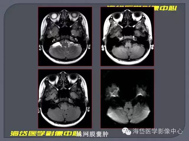 彙總橋小腦角區病變mr