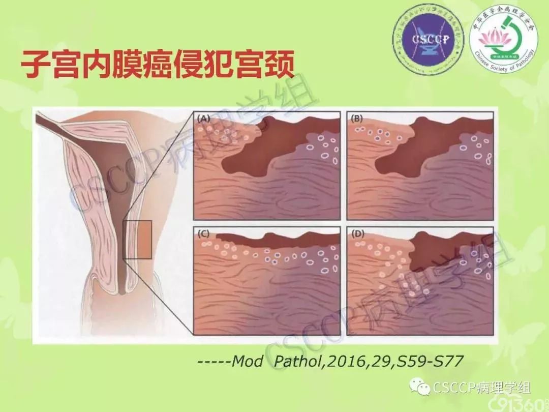 宮頸與子宮病變病理標本取材