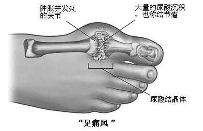 痛风 位置图片