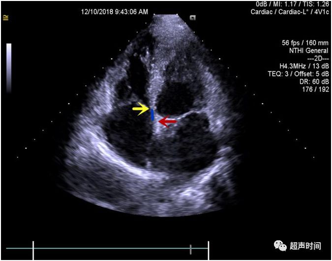三尖瓣瓣叶超声区分图图片