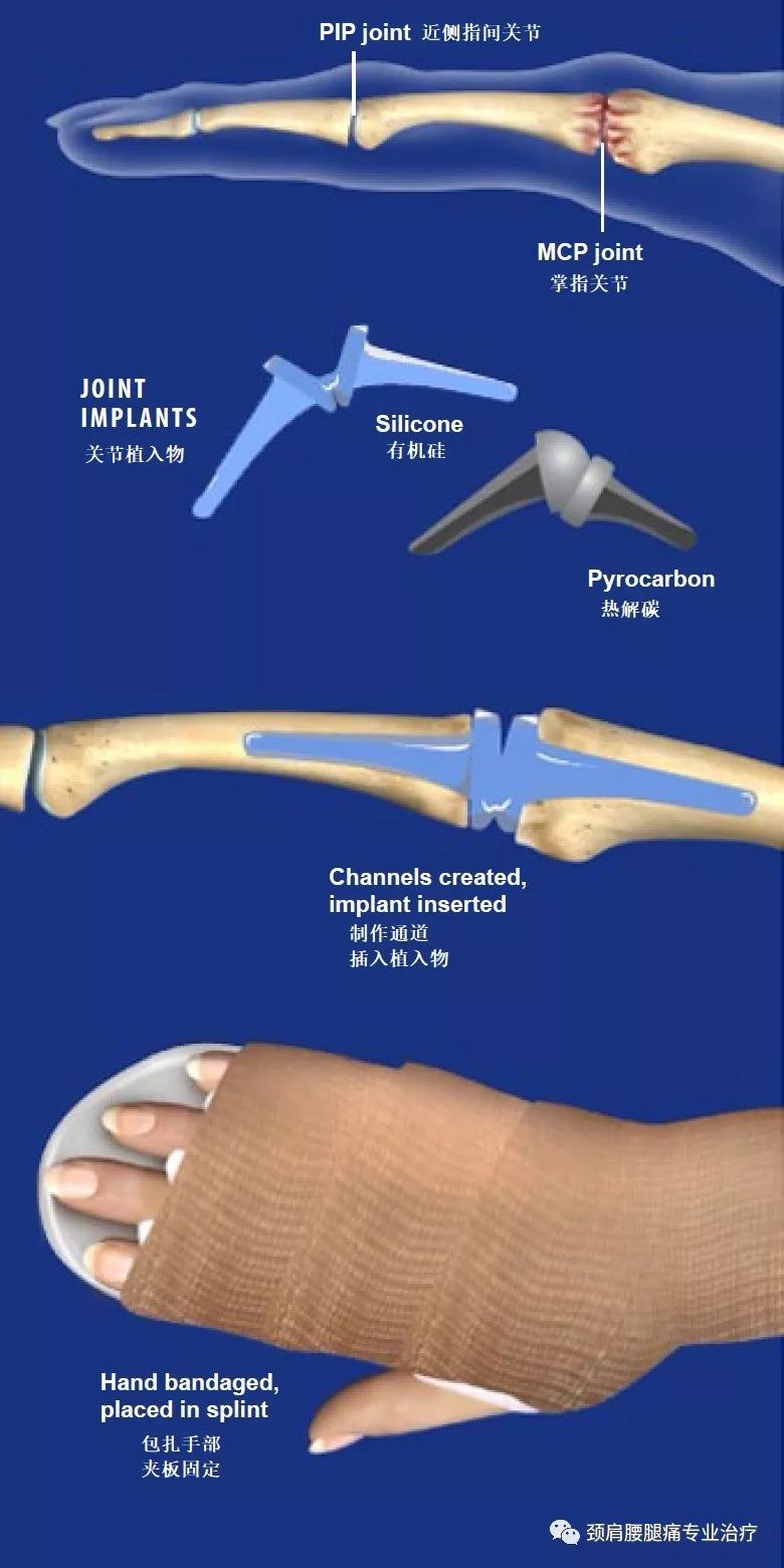 中英文字幕手指人工关节置换artificialjointreplacementofthefinger