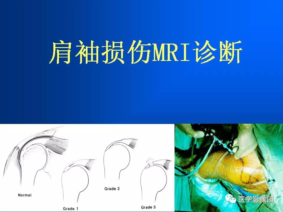 肩袖损伤mri诊断影像天地