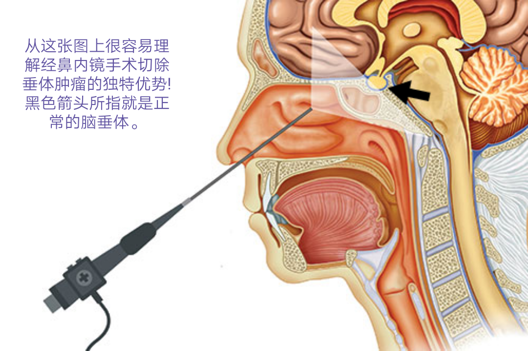 经鼻蝶垂体瘤手术步骤图片