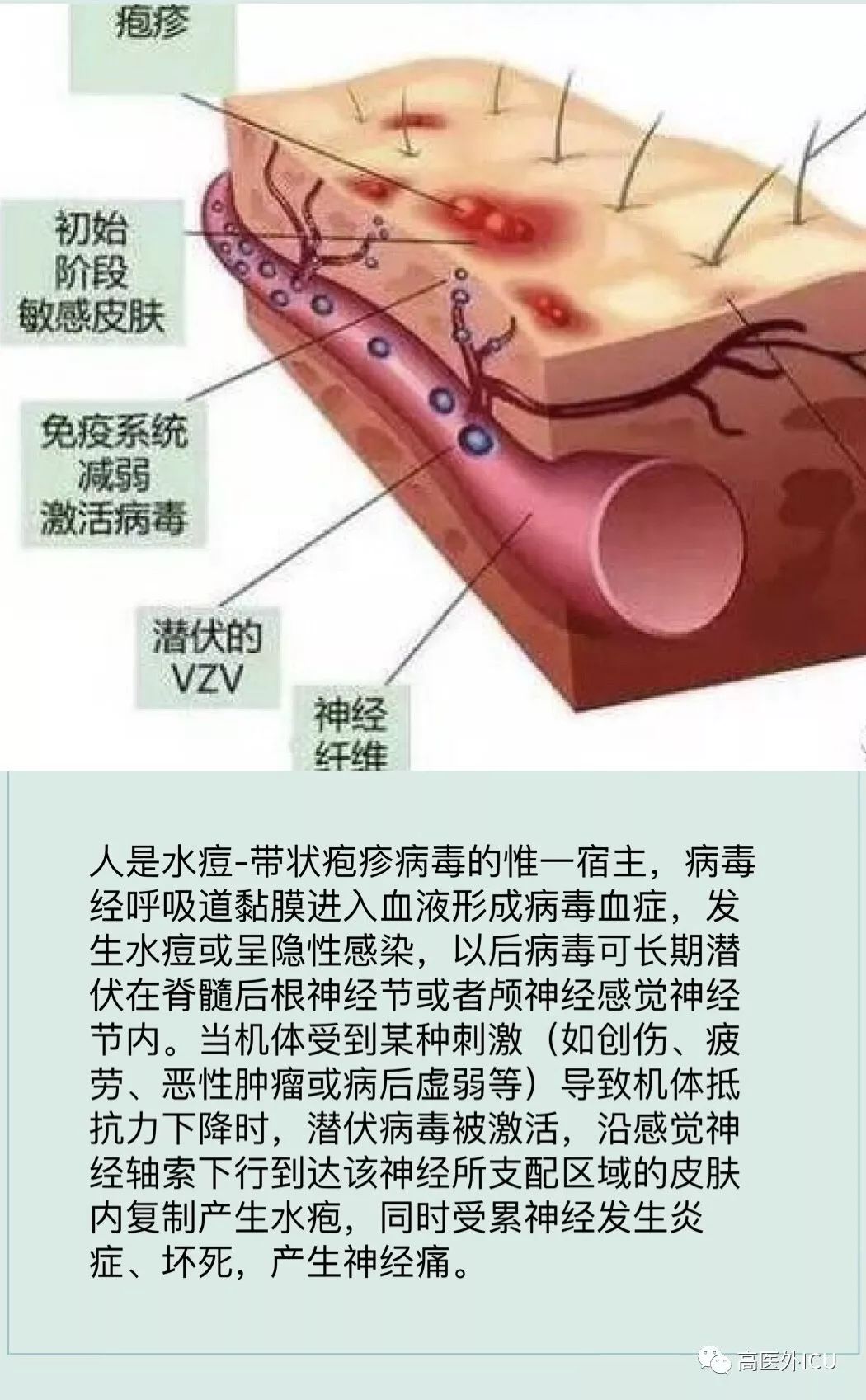 带状疱疹是由水痘