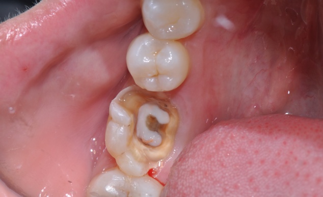 牙髓坏死蛀牙图片