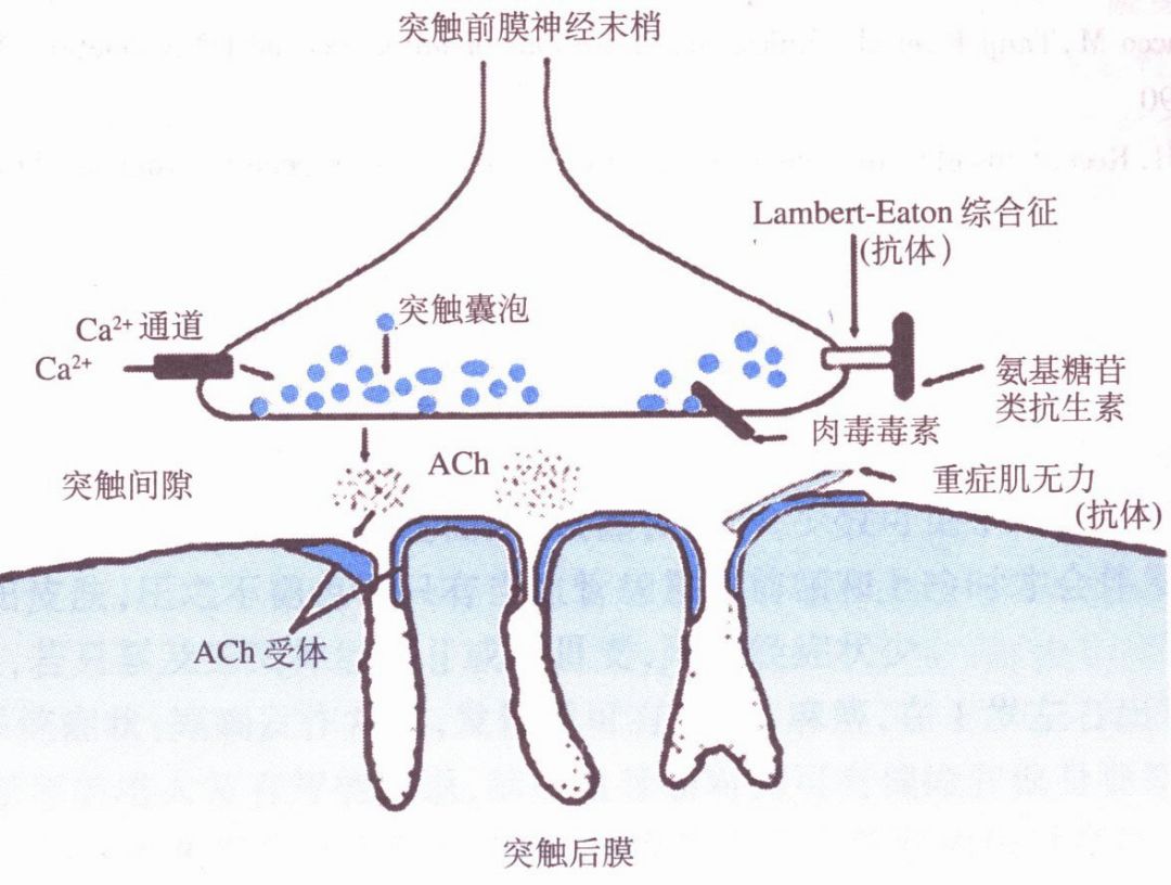 重症肌无力图解图片