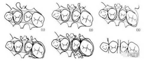 值得收藏牙医基本技能口内缝合术文字示意图及视频