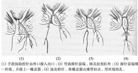 肛瘘挂线皮筋脱落图片图片