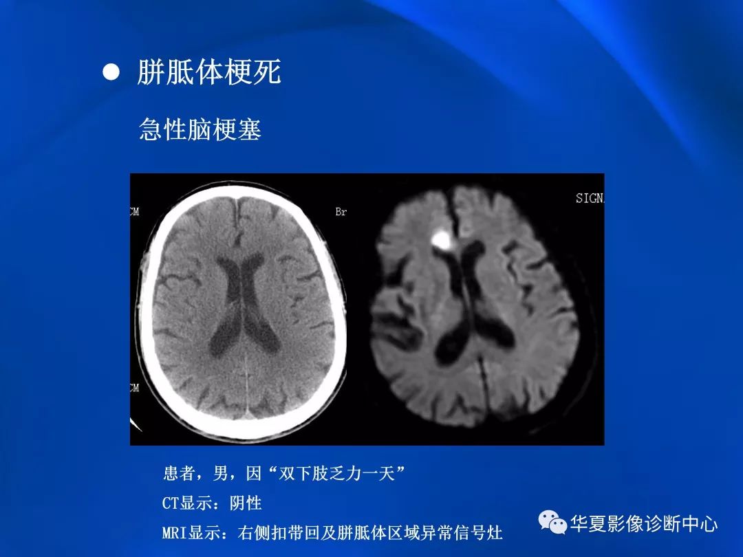 胼胝体病变影像学表现