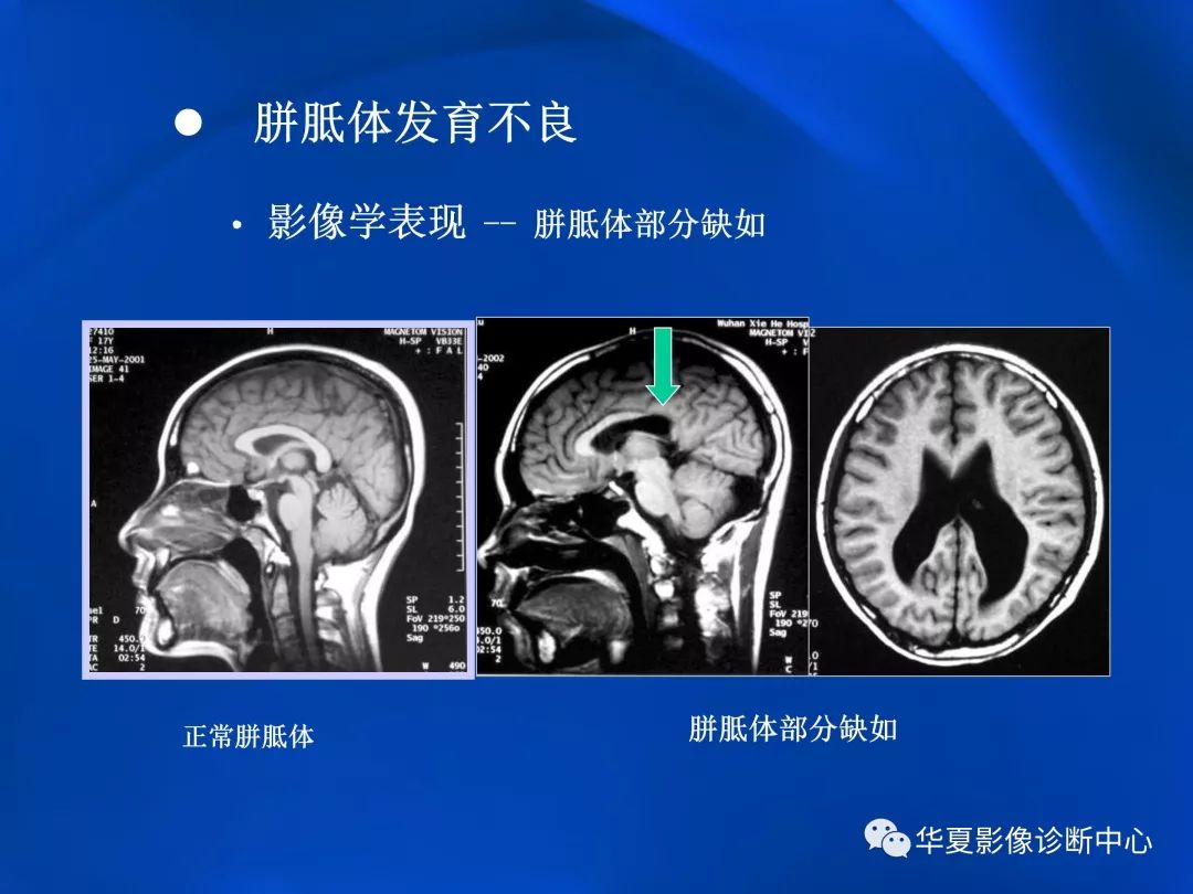 胼胝体病变影像学表现