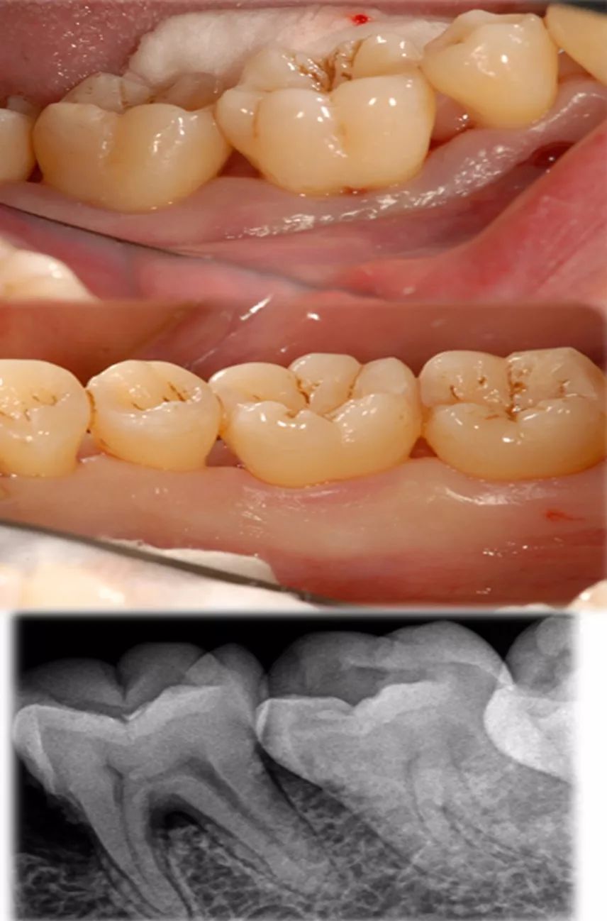 牙周炎症状图片及治疗图片