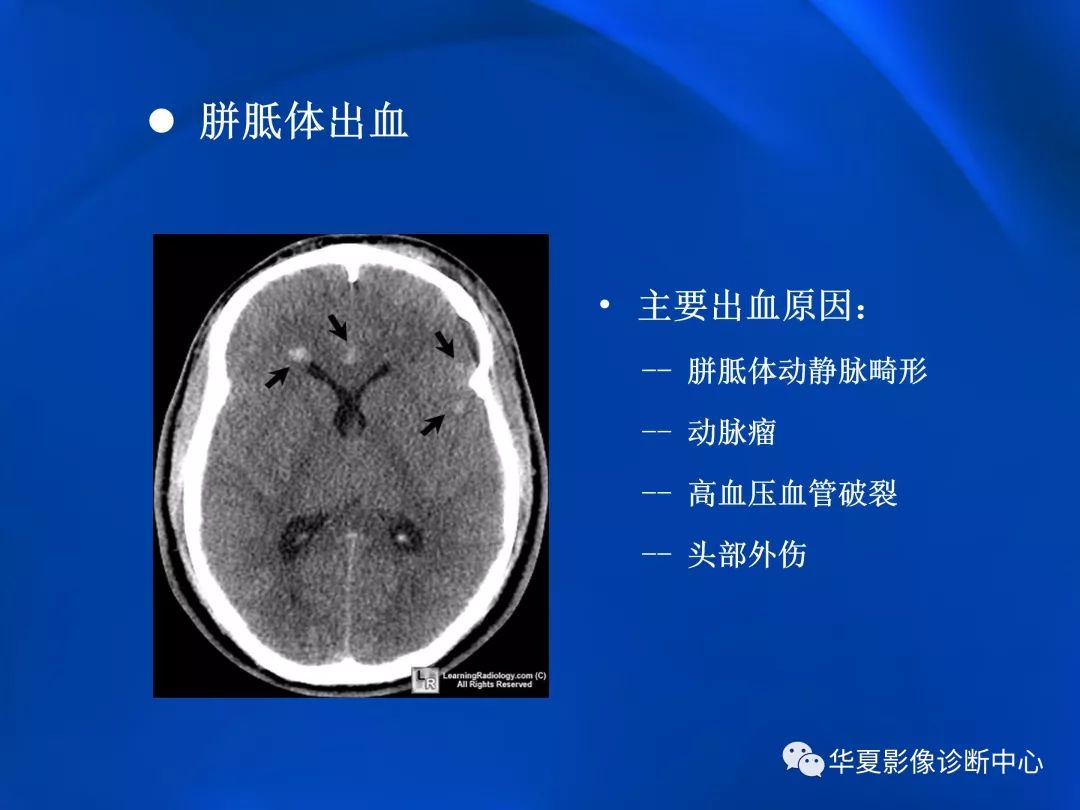 胼胝体膝部梗塞图片