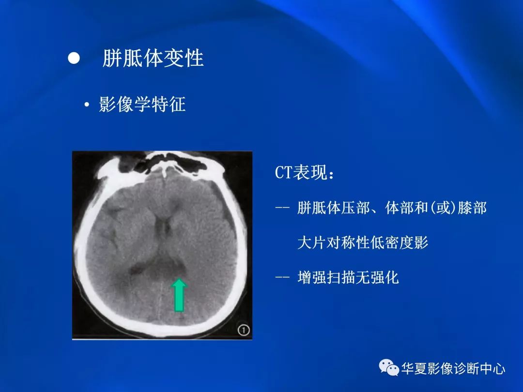 胼胝体影像图图片