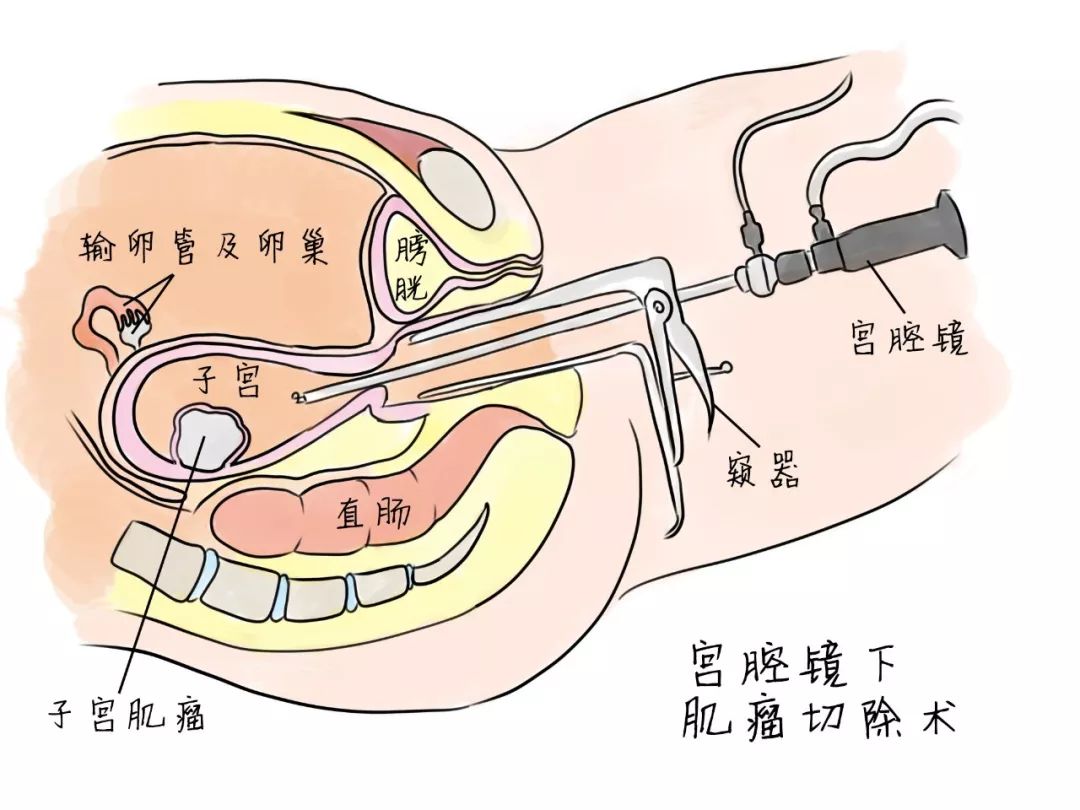 子宫肌瘤手术全过程图图片