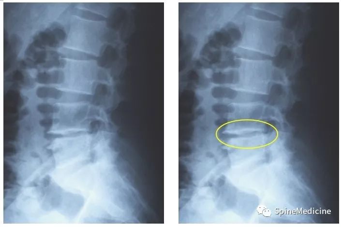 正常棘突序列)小编为大家提供正常腰椎的影像资料和错误腰椎的影像