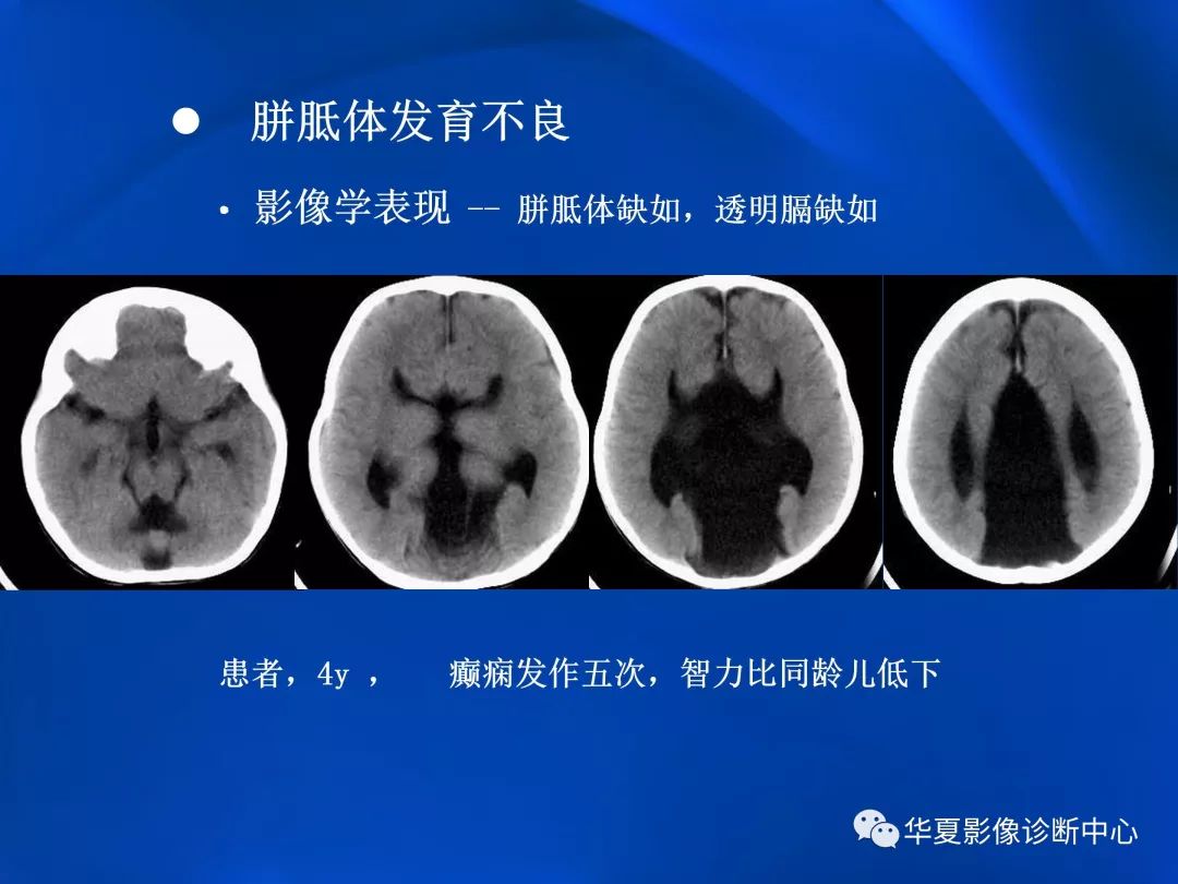 胼胝体病变影像学表现