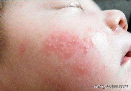 婴儿湿疹是婴儿时期常见的一种皮肤病,属于变态反应性(或称为过敏性)