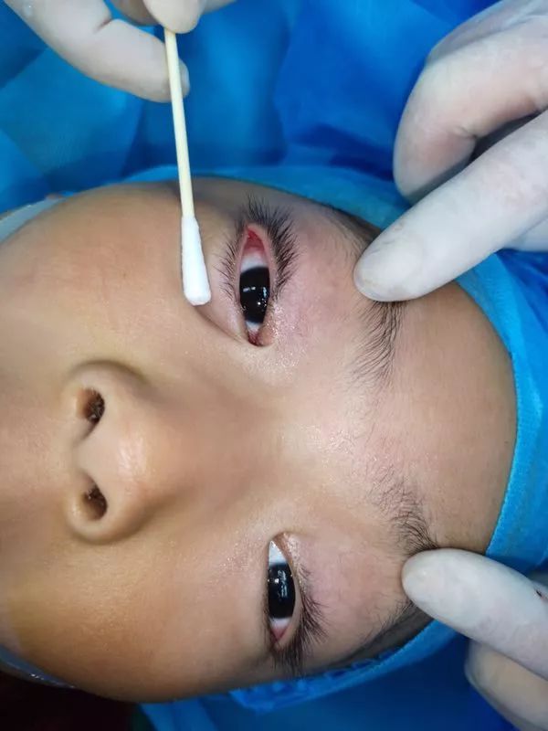 儿童眼睛动手术图片图片