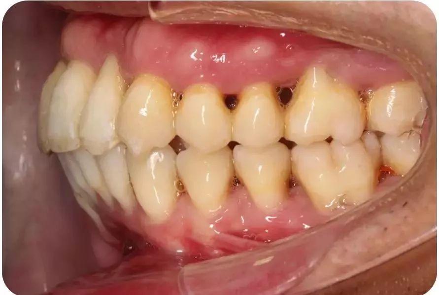 成人慢性牙周炎系统性治疗一例以菌斑控制为导向的牙