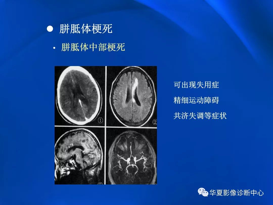 胼胝体病变影像学表现