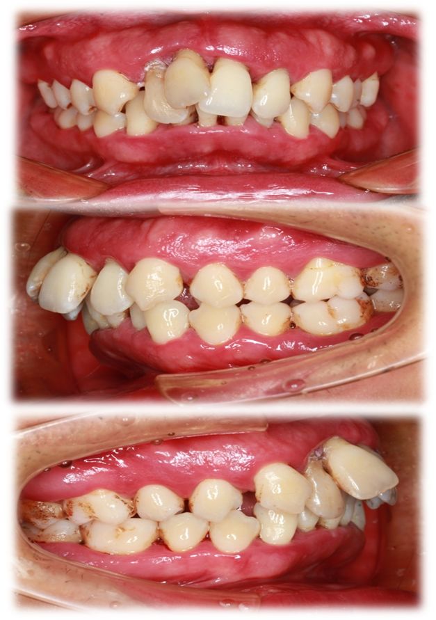 成人慢性牙周炎系统性治疗一例 