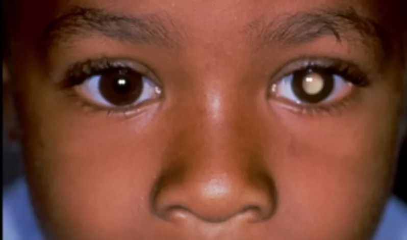 如果发现宝宝的黑眼珠变得特别大,有时候看起来还没有那么透亮,就要