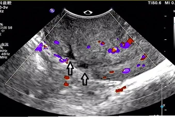 排除内分泌,宫颈,子宫内膜等因素,在超声科医生的细致检查下,结合影像