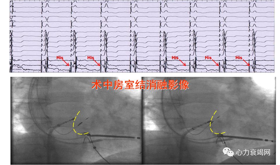 术中hbp起搏测试心电图沈阳军区总医院 梁延春,于海波等房室结消融