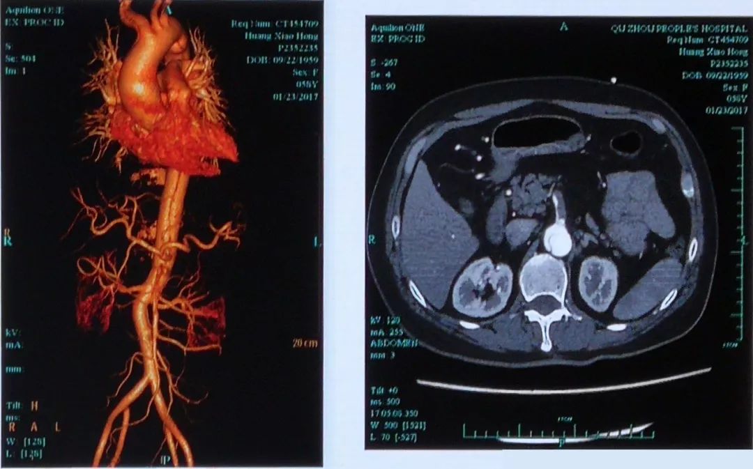 cta显示stanford a型主动脉夹层,夹层累及腹腔干,肠系膜上动脉,腹腔干