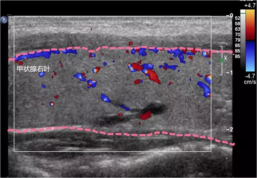 甲状腺上下动脉超声图图片