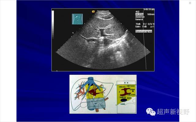 超声微课堂肝脏超声扫查