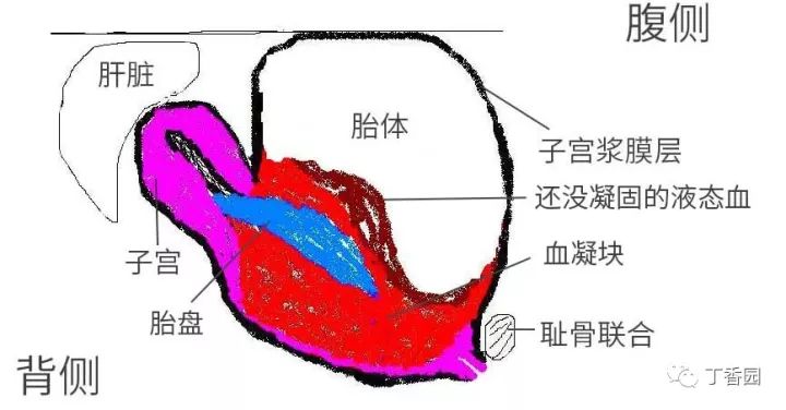 破出子宮的胎體示意圖(矢狀面)