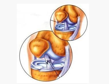 北京京醫二體二角開合粘合法 徹底治療半月板損傷