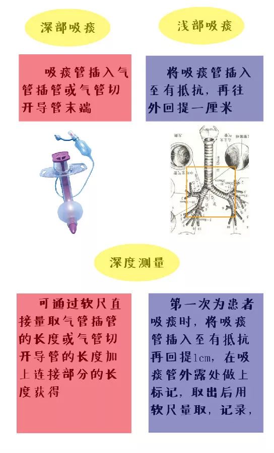 吸痰示意图图片