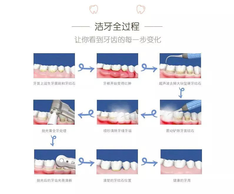 洁牙顺序图图片