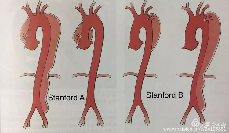 主动脉夹层stanford图片