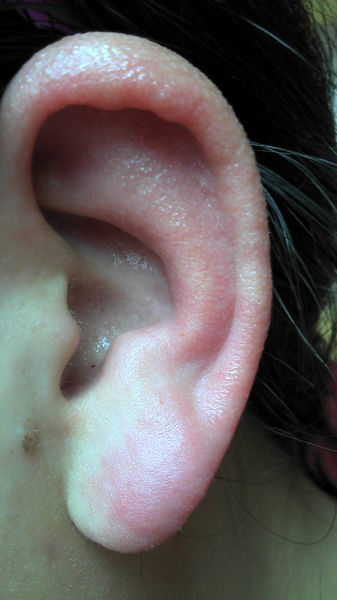 耳朵冻疮图片治疗方法图片