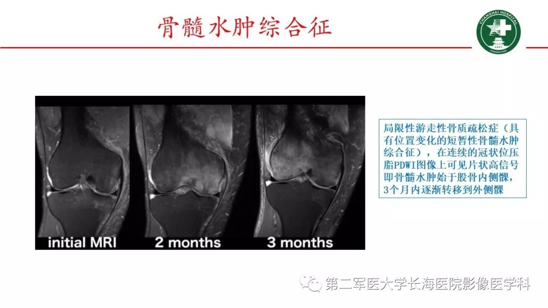 胫骨平台骨髓水肿图片