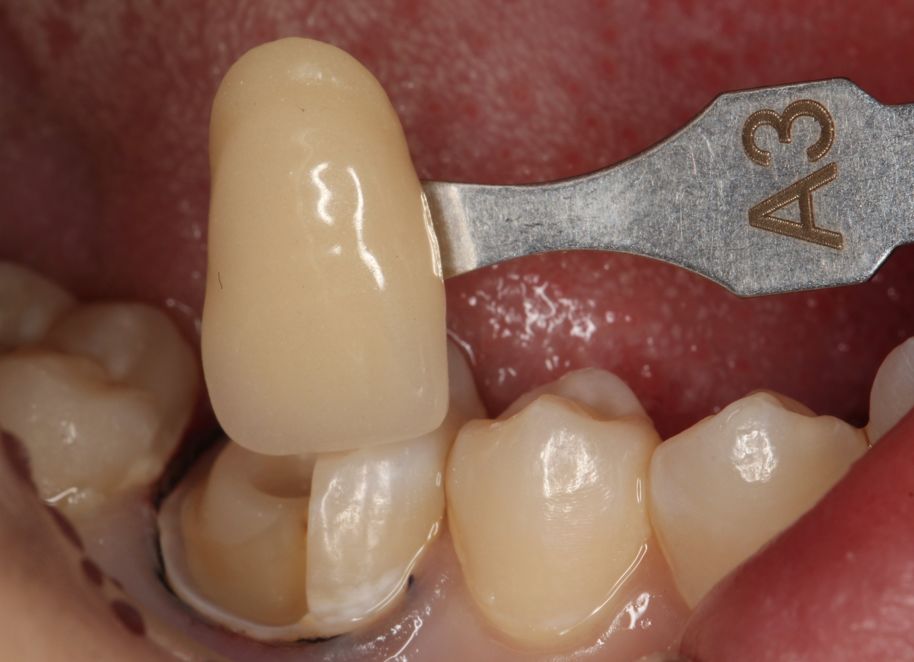 金赛义齿嵌体修复病例(四)