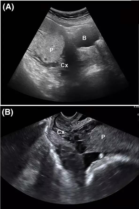 胎盘位置彩超图图片