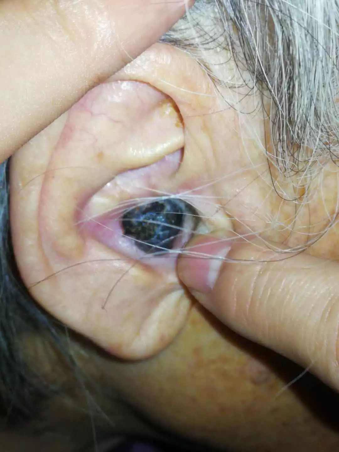杭州一奶奶年轻时就爱掏耳朵,结果里面长出了罕见的癌!
