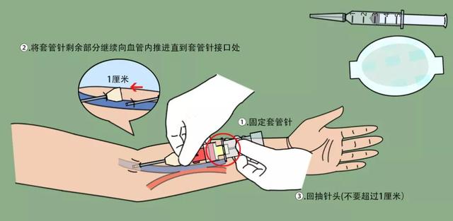 留置针接口原理图图片