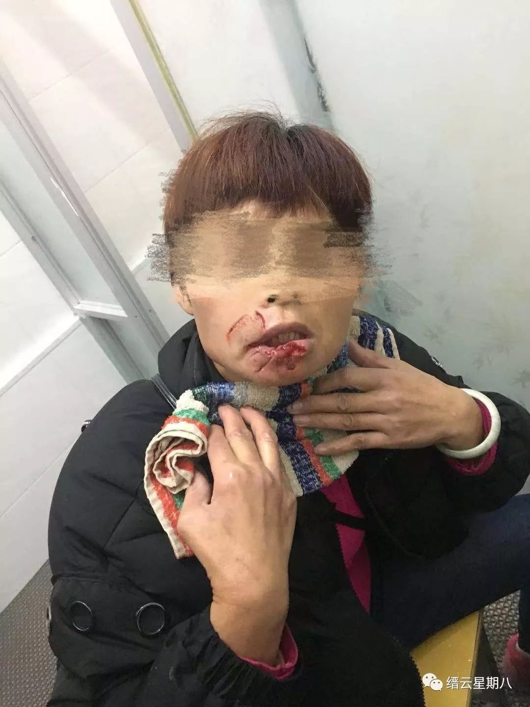 可怕丽水一53岁女子被自家狗咬伤嘴唇少了一块肉