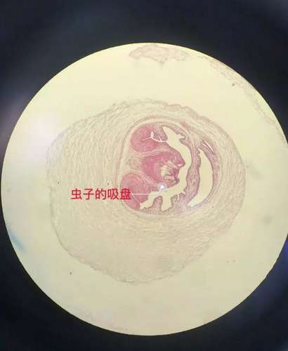 肝棘球蚴病理切片图片