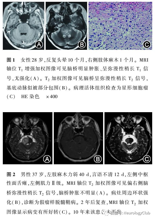 而實際上2007年已將神經上皮組織腫瘤分成星形細胞瘤,少突膠質細胞 