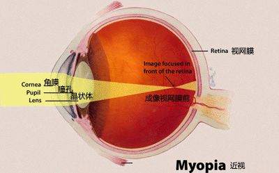 近视眼视网膜成像图图片
