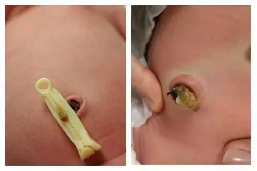 保持宝宝肚脐的干爽很重要,因为被扎结的脐带是一种坏死的组织,如果