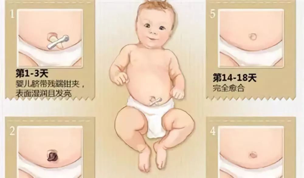 新生儿脐带脱落过程图图片