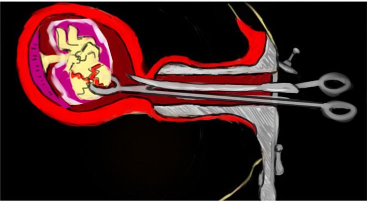 妇产科医生用一组图揭示堕胎的真相:堕胎,到底有多残忍?